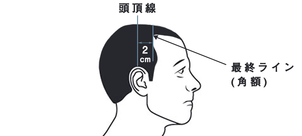 これってm字ハゲ 生え際の状態による判断基準と対策 東京青山クリニック